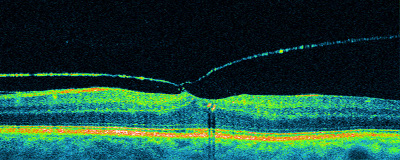 tomografia optica coherente oct desprendimiento de vitreo